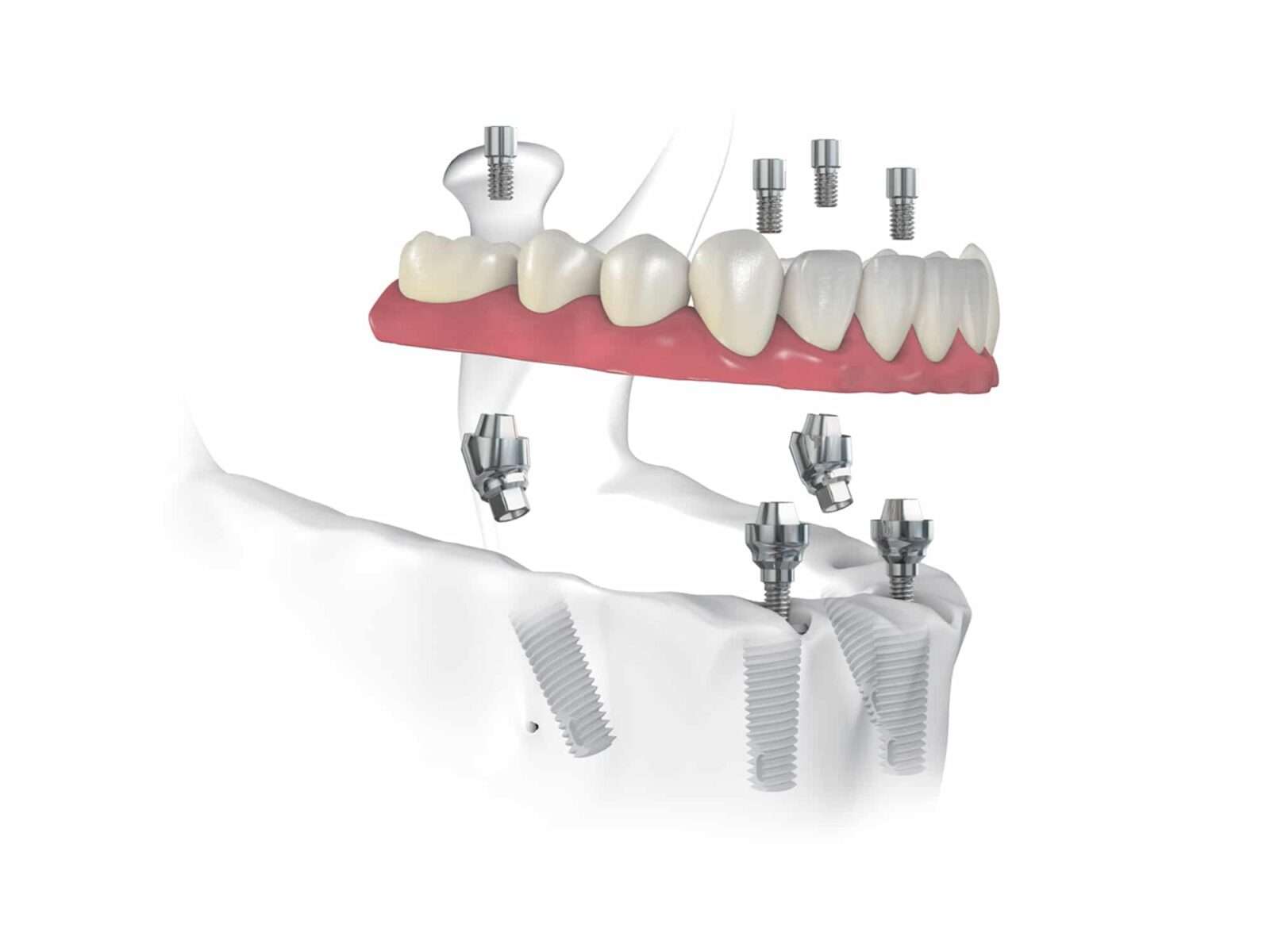 Implanturi dentare: avantaje