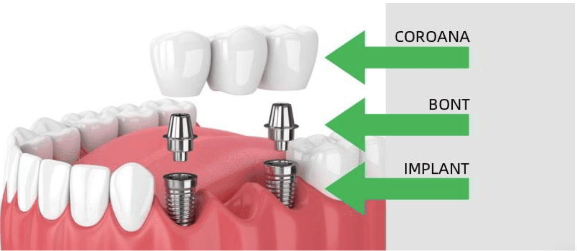 Cum să-ți faci implant dentar rapid? 1 Implant-Dentar